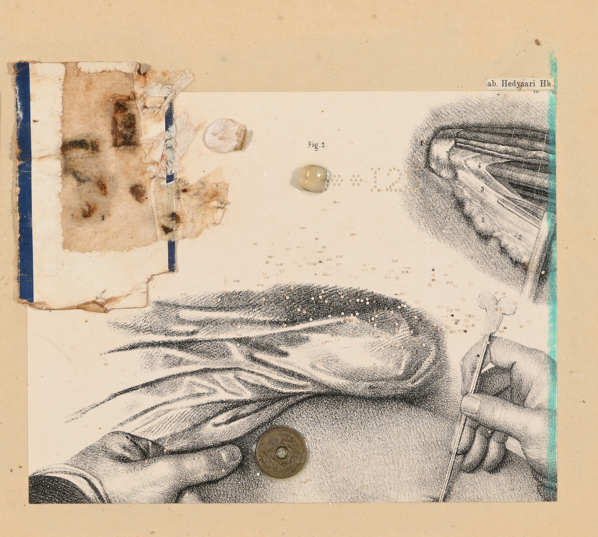 Daniel Spoerri, Collage aus der Serie "La médicine opératoire dessinée d'après nature par N.H. Jacob"