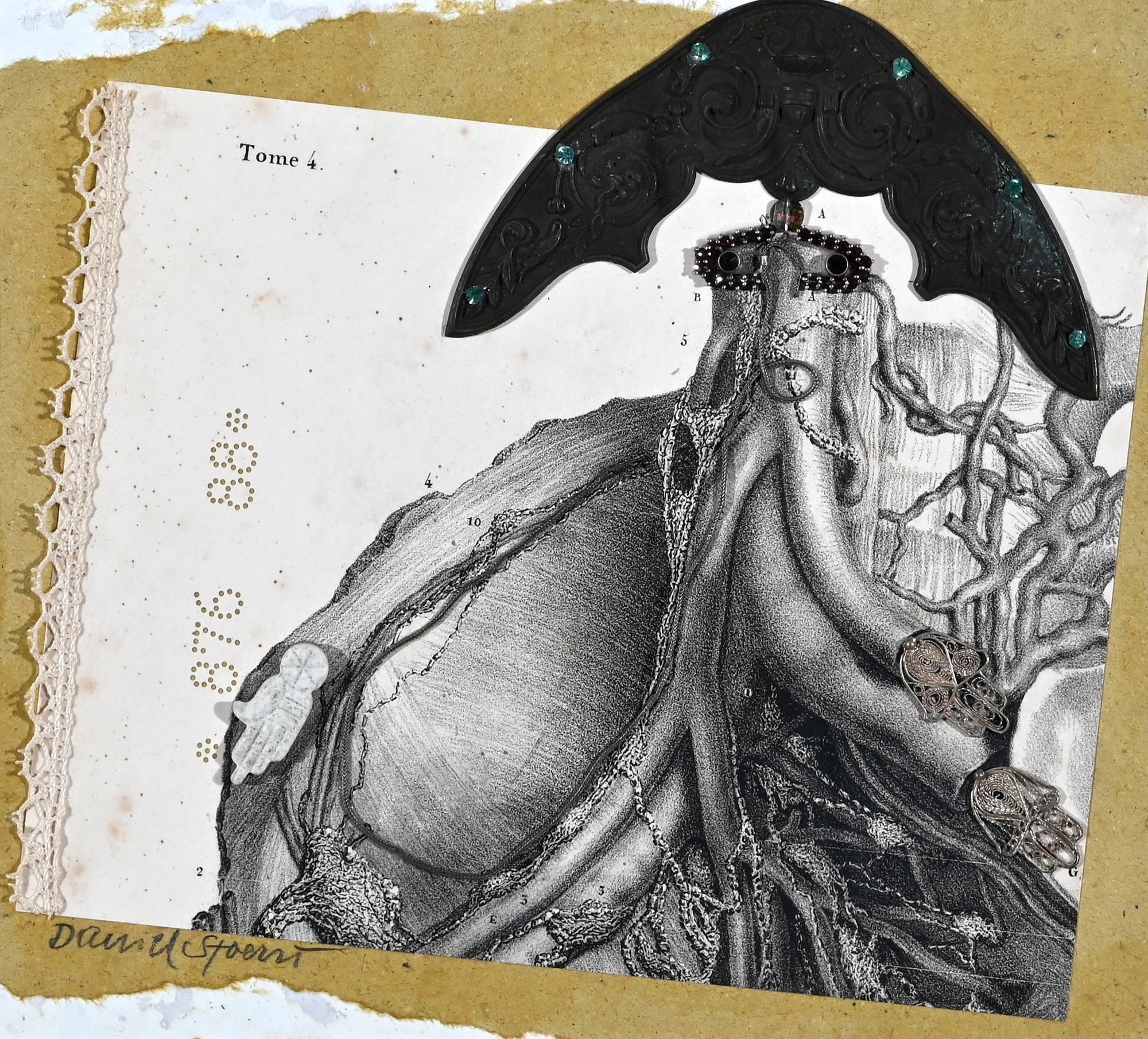 Daniel Spoerri, Collage aus der Serie "La médicine opératoire dessinée d'après nature par N.H. Jacob"