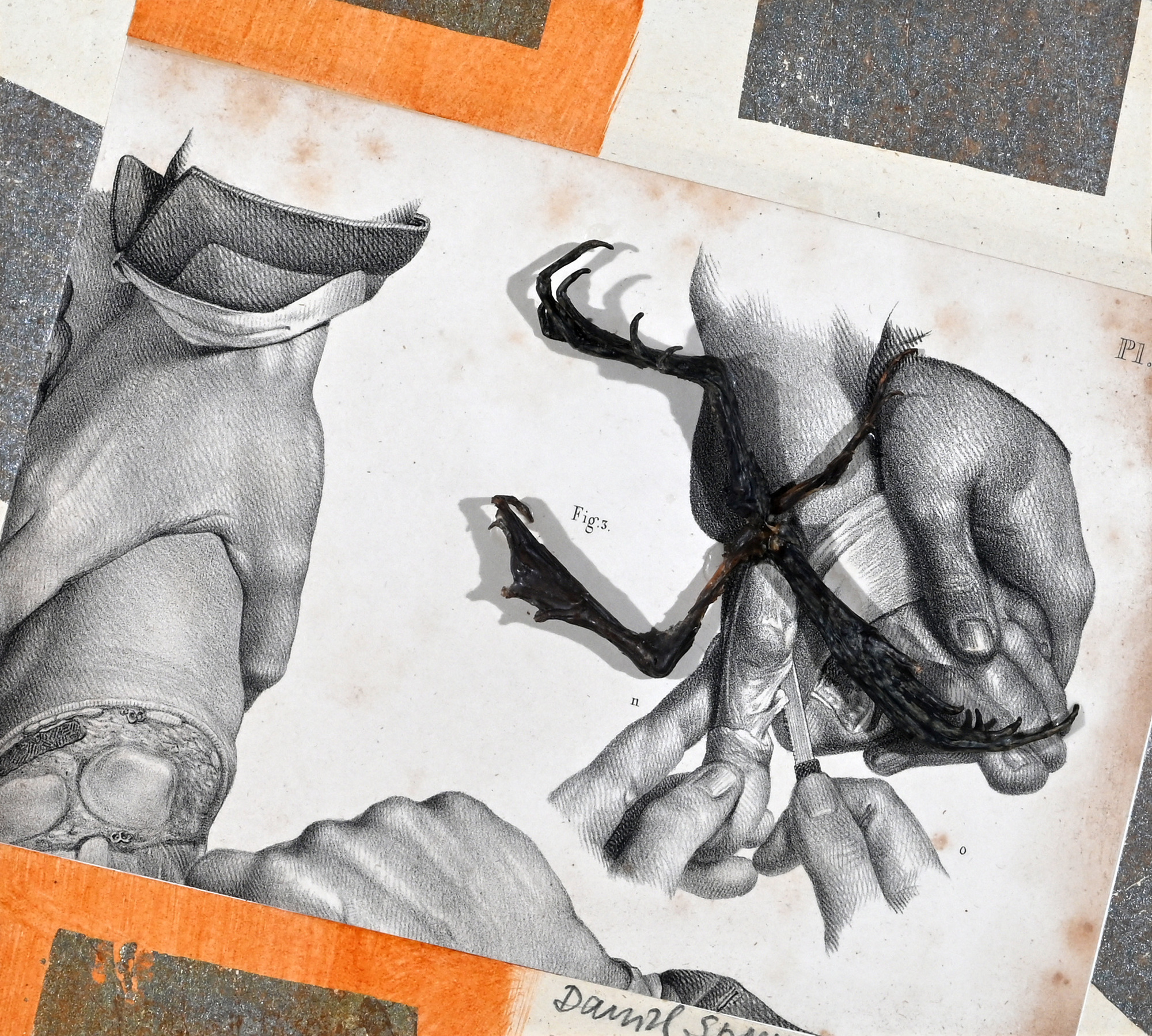 Daniel Spoerri, Collage from series "La médicine opératoire dessinée d'après nature par N.H. Jacob"